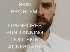 Men’s skin Pigmentation – Open Pore in Islamabad